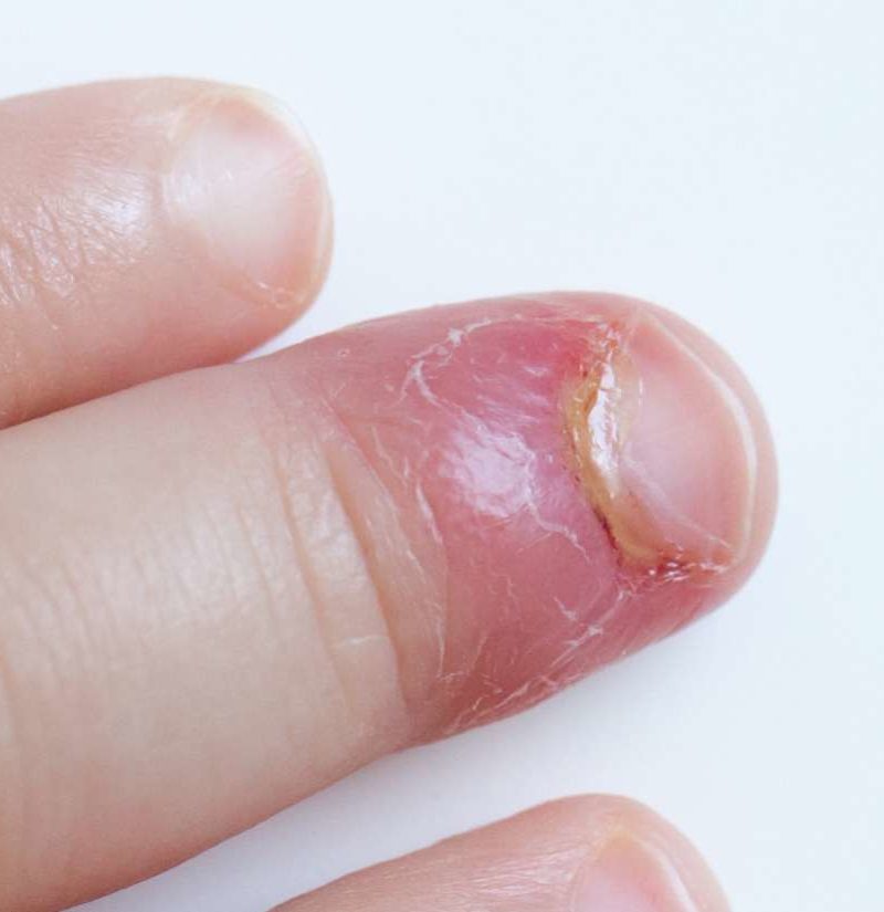 Paronychia Causes And Treatment Of An Infected Nail
