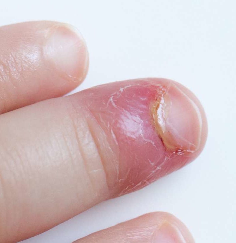 what-are-the-common-causes-of-pus-in-the-finger