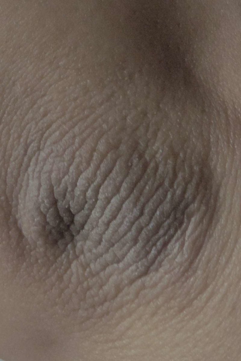 Acanthosis nigricans: Causes, symptoms, treatment, and pictures