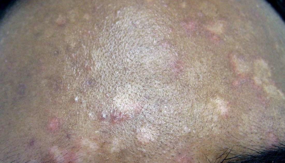 Manchas en piel: Posibles causas y tratamientos