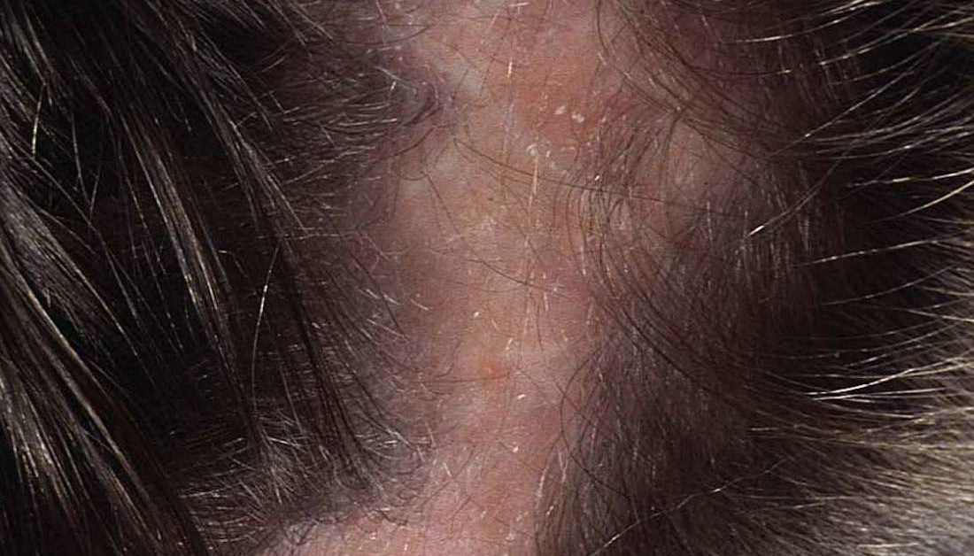 Ringworm, Scalp (Tinea Capitis) Condition, Treatments and Pictures for  Children - Skinsight