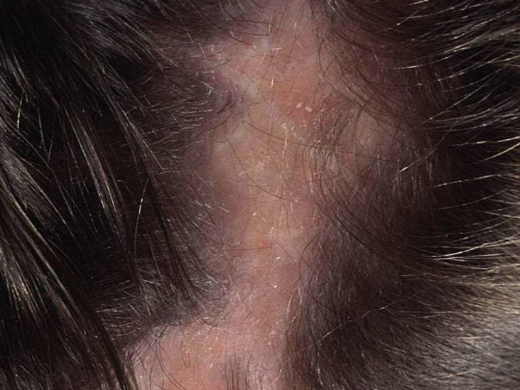 Tingling scalp: Causes, symptoms, and treatment