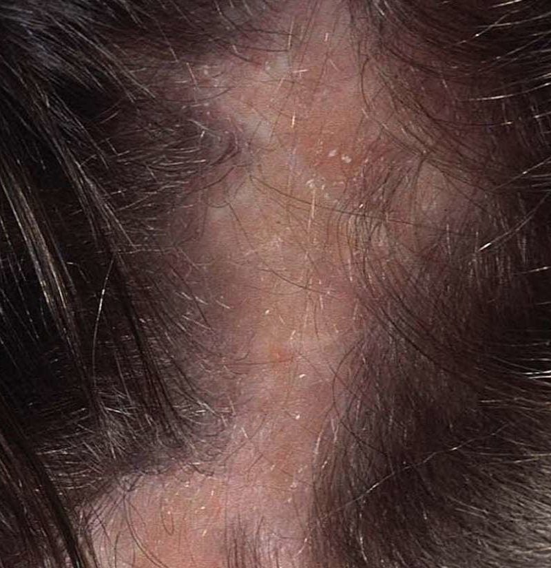 Scalp Infections Causes Symptoms Treatments And Pictures