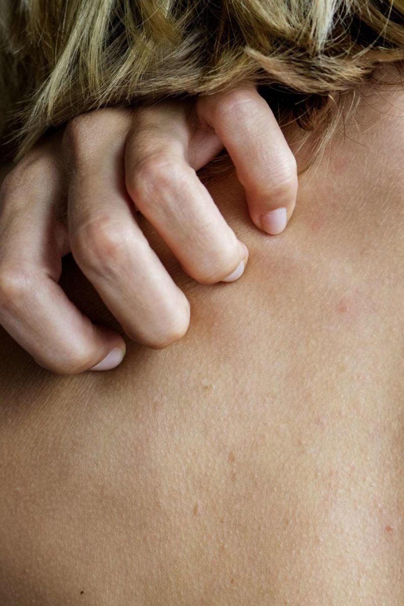 Lichen planus vs. psoriasis Symptoms, causes, and treatments