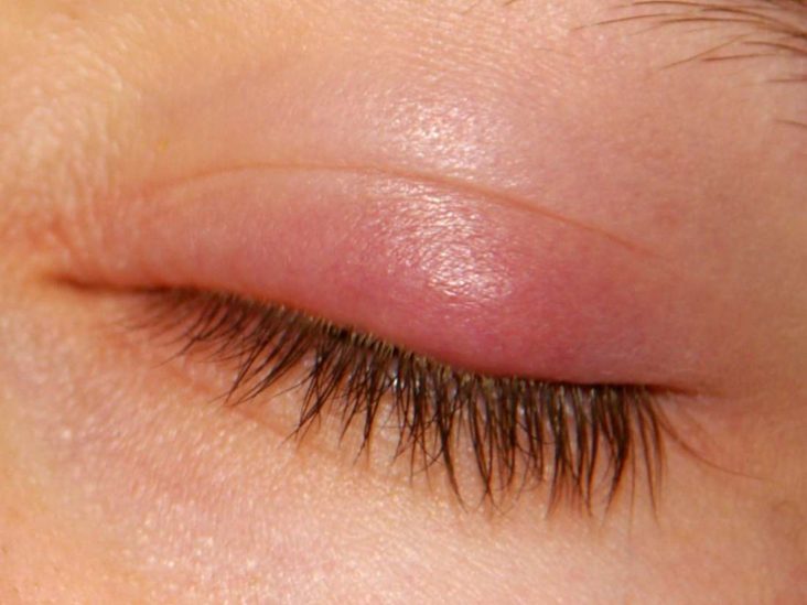 How To Get Rid Of A Stye On My Eyelid