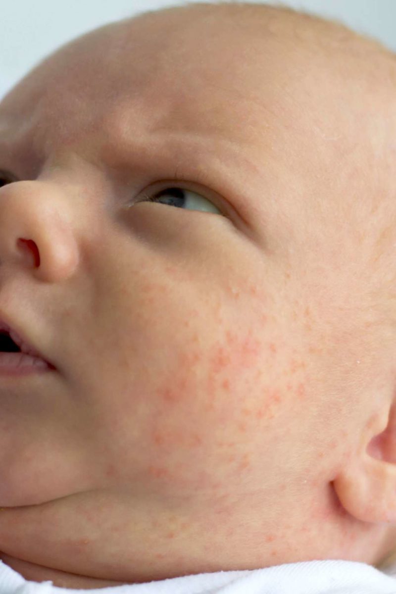 Baby red rash on face and neck