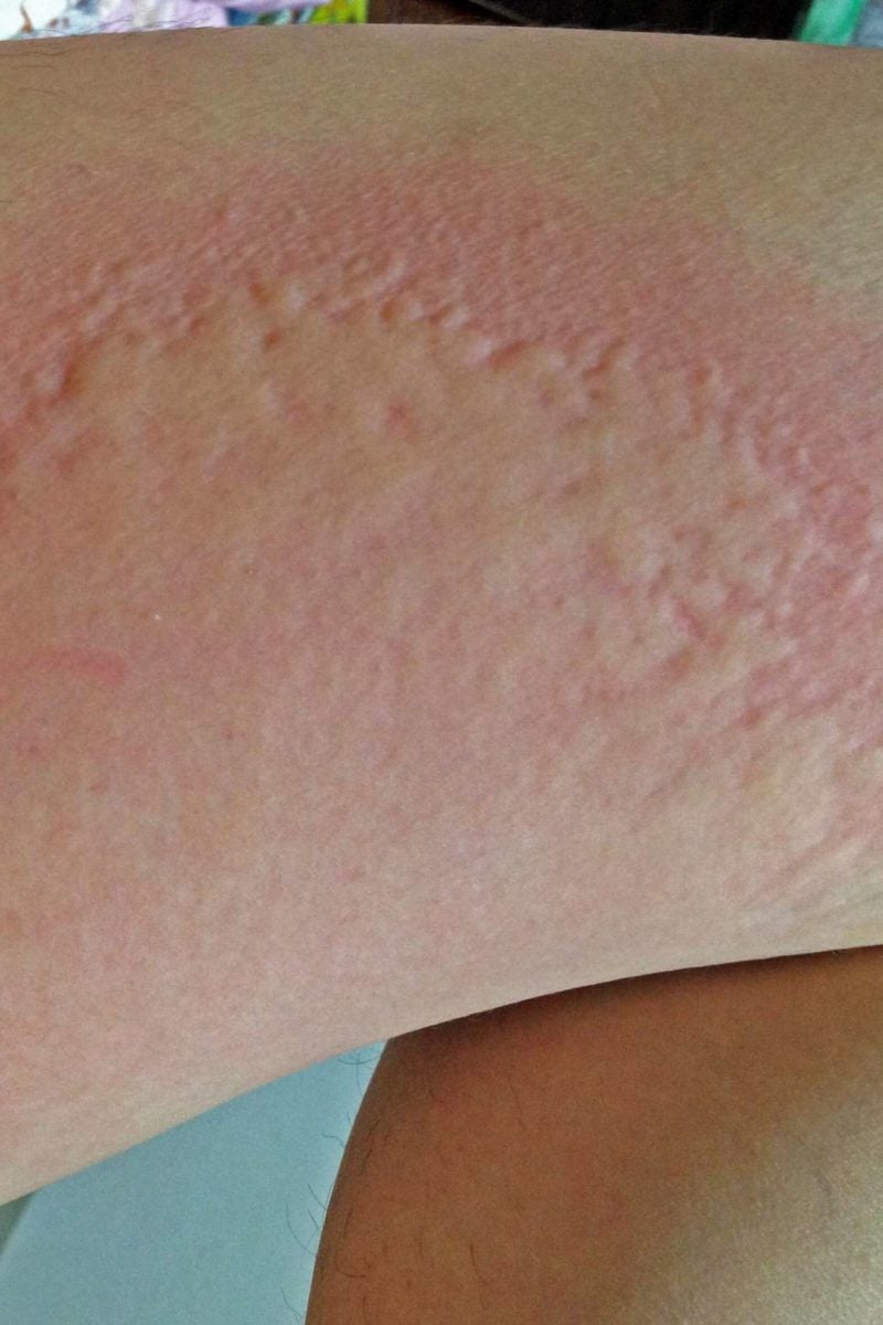 is-it-a-hepatitis-c-rash