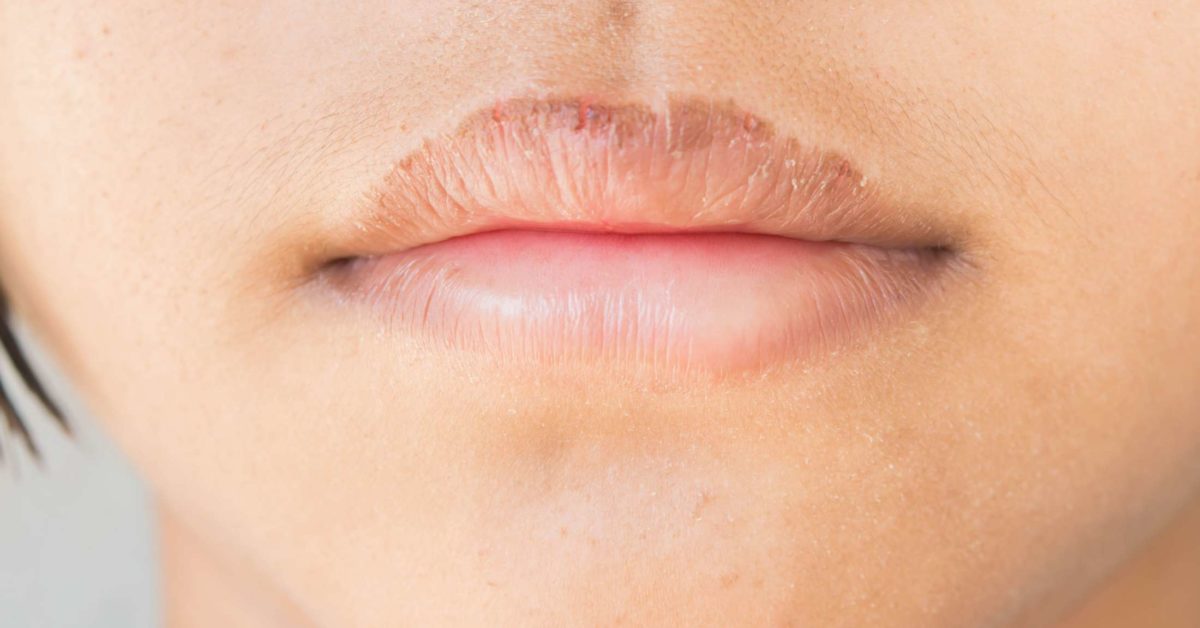 How to get rid of chapped lips: 6 ways