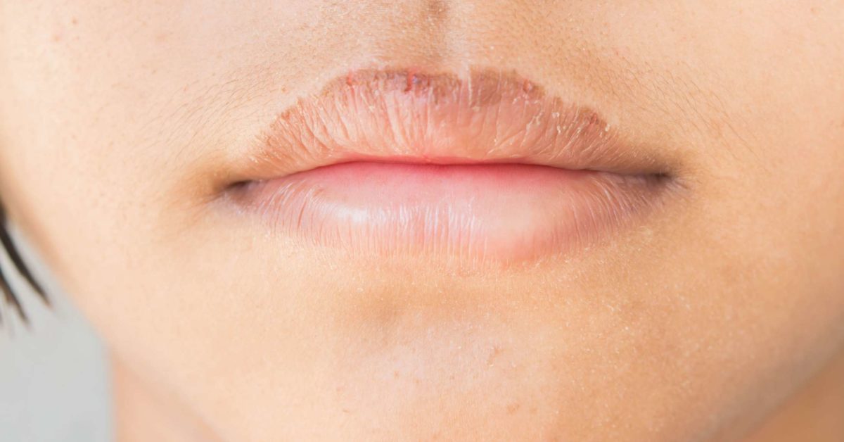 How To Get Rid Of A Cut On Your Lip