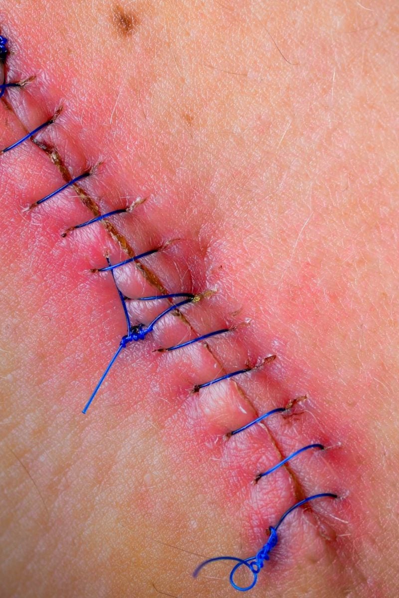 Will it hurt when my stitches are removed after surgery? (Video)