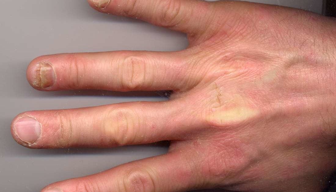 Psoriatic Arthritis And Nails Changes Pictures And Treatment