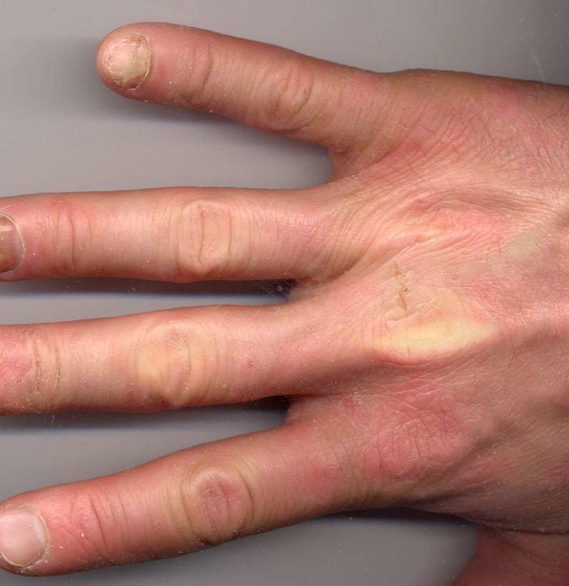 Psoriatic Arthritis And Nails Changes Pictures And Treatment