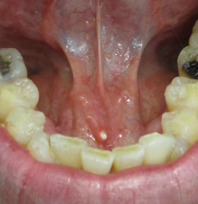 Oral Lesions Under Tongue