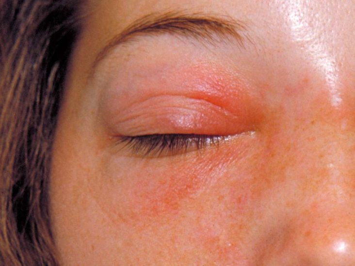 Rash Around Eyes Causes Symptoms And Treatment