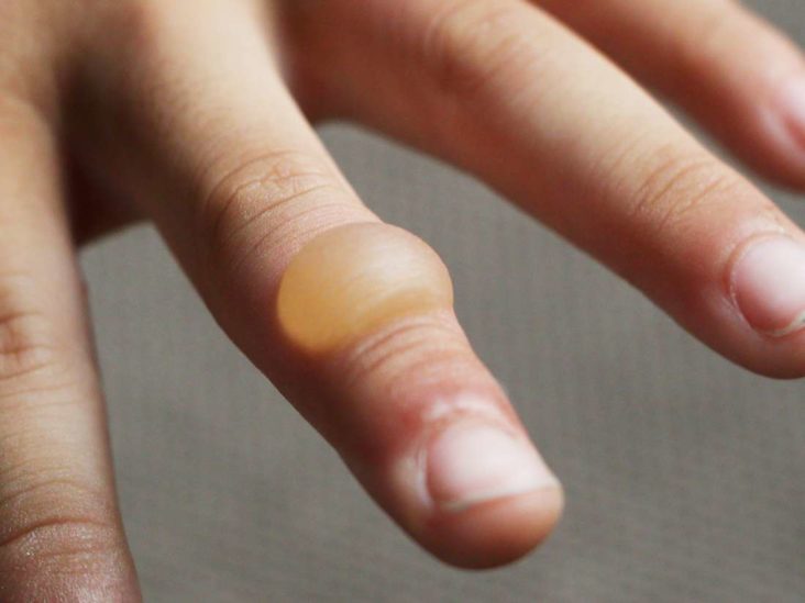 infected blood blister on finger