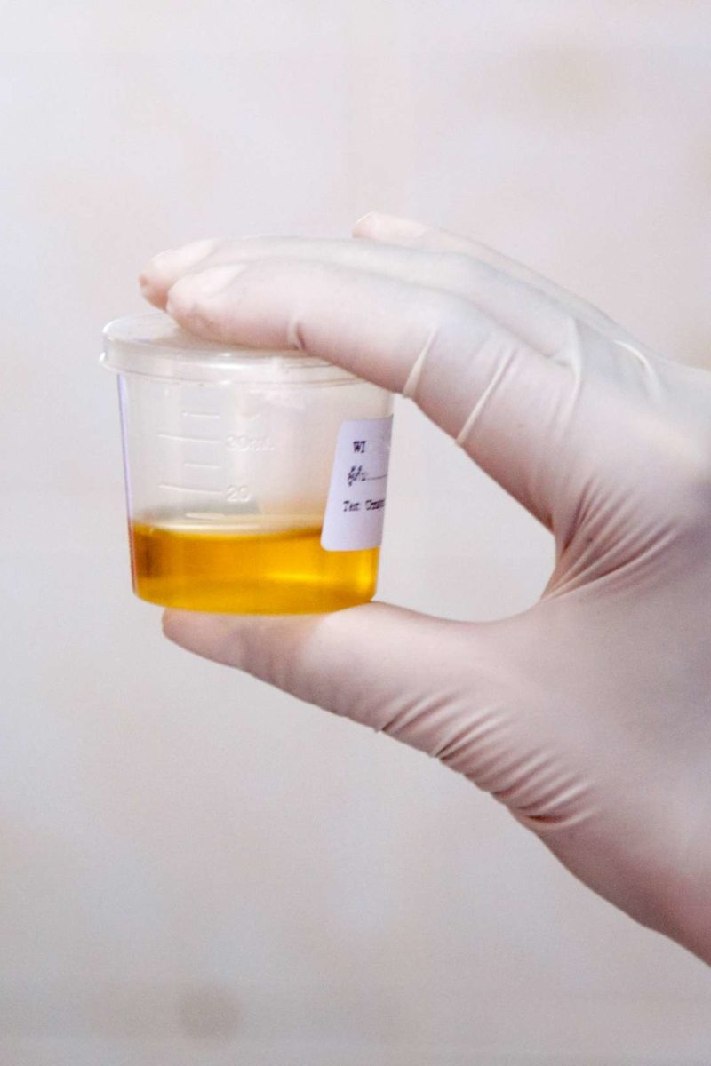 24 hour urine cortisol test