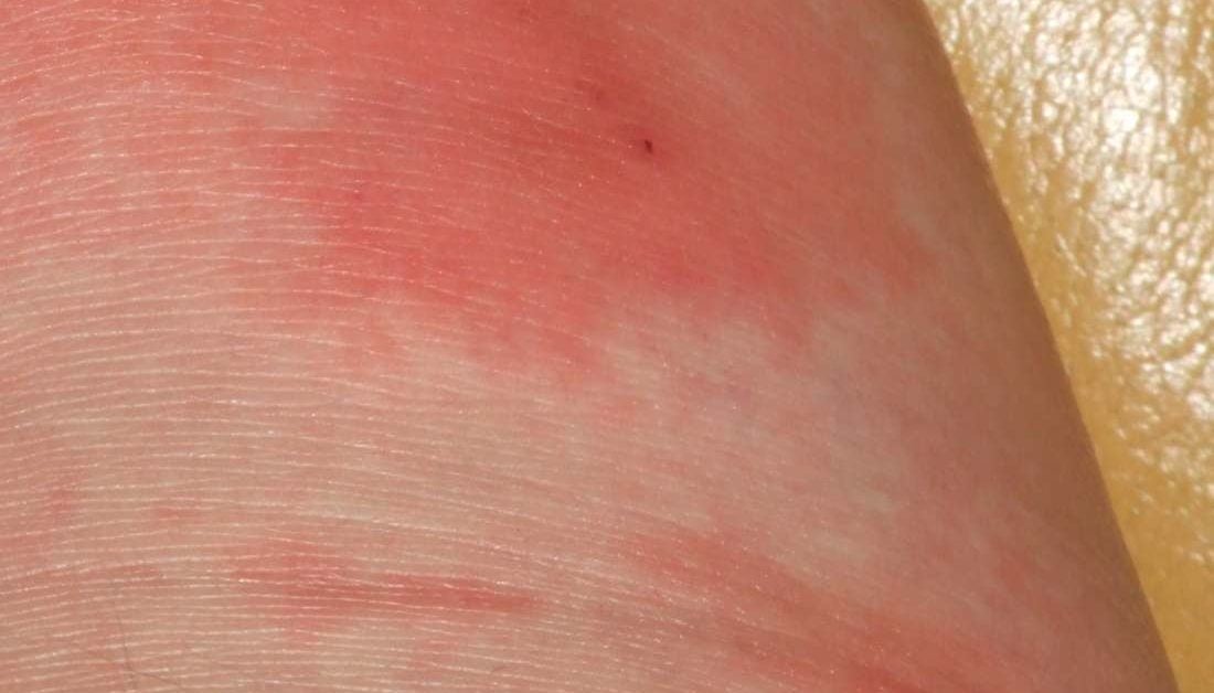 What Can Cause A Fungal Skin Rash