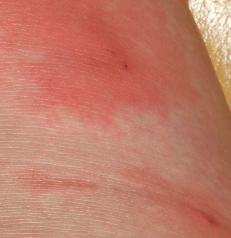 fungal-rash-on-skin