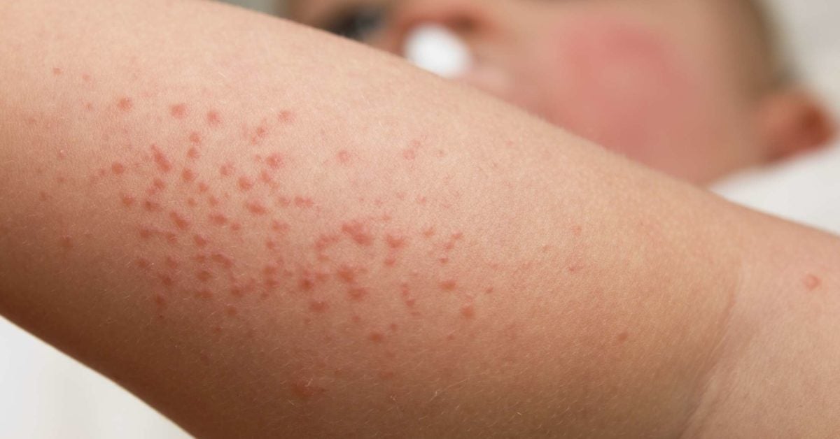 Baby Heat Rash Types Diagnosis And Treatment