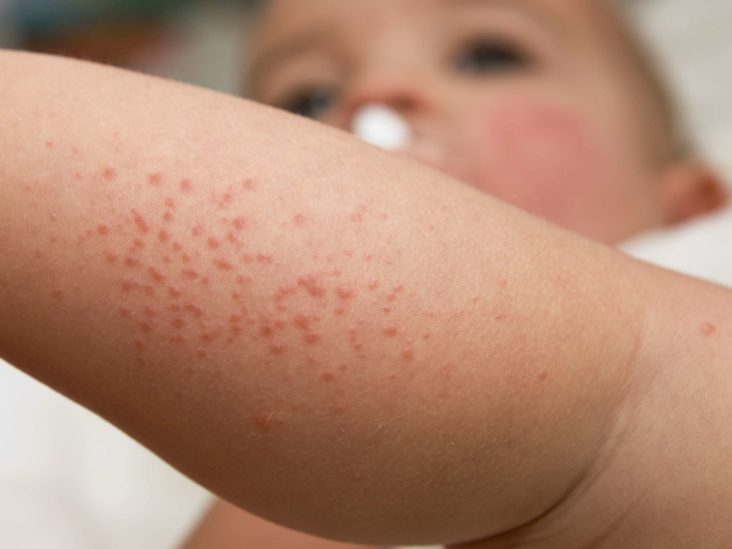 Wonder Wifey Kinds Of Rashes In Babies