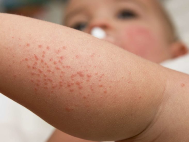 Baby allergies rash treatment