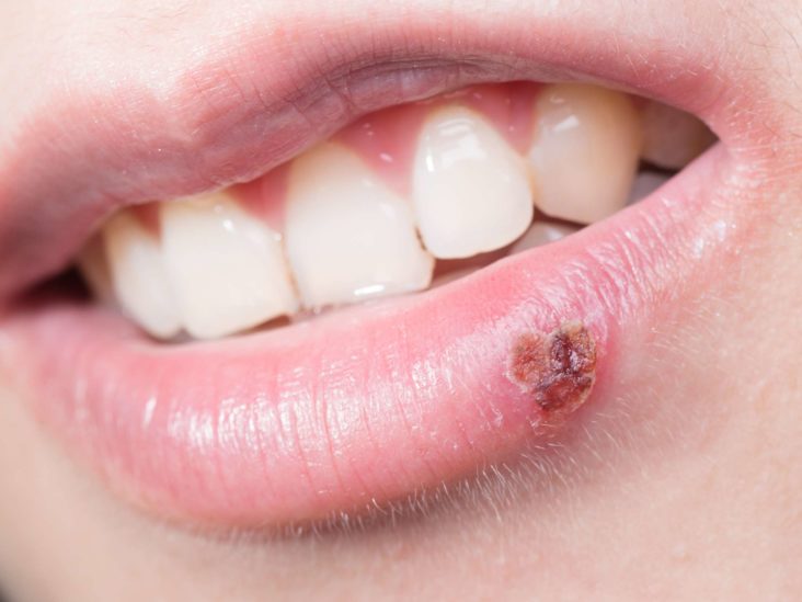 How To Get Rid Of A Scab On My Lip - Kingdomclimate Murasakinyack