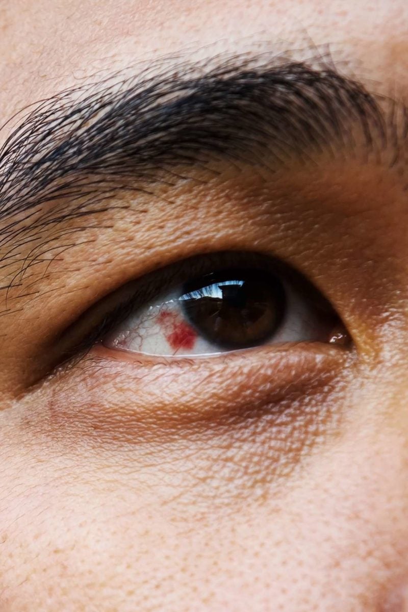 red-spot-on-eye-causes-and-treatment