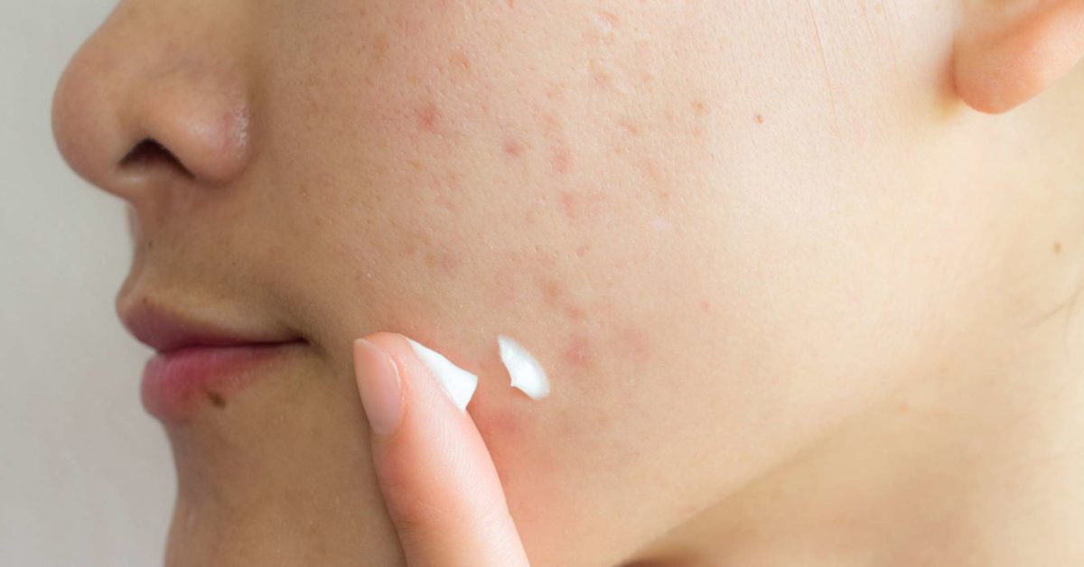 Home remedies to remove acne scars quickly