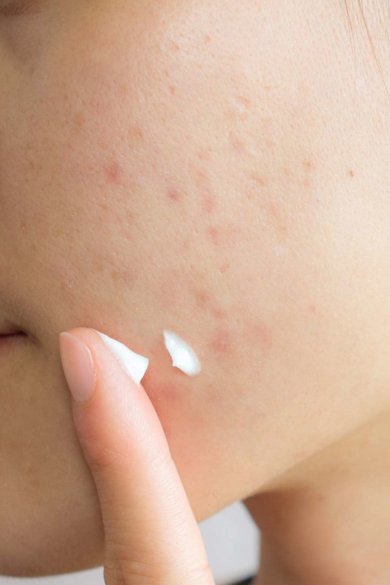 Pimples what helps redness of 10 Best