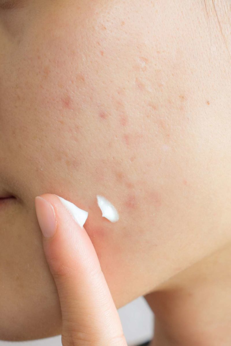 How To Get Rid Of Acne Scars Treatments And Home Remedies