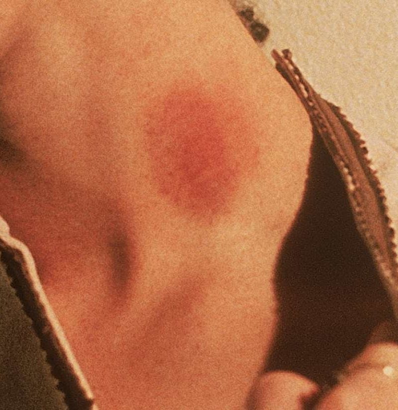 What Can Cause Hickey Like Marks