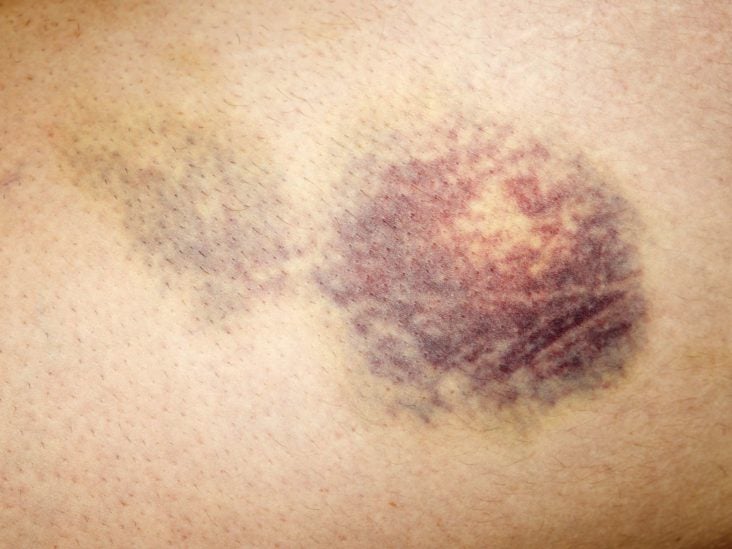 Bruise with white center