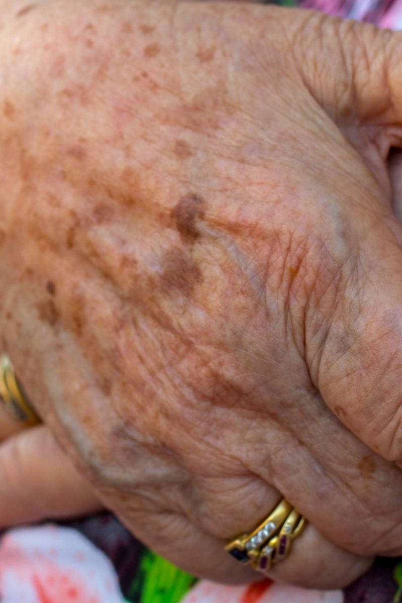 black dots on hands