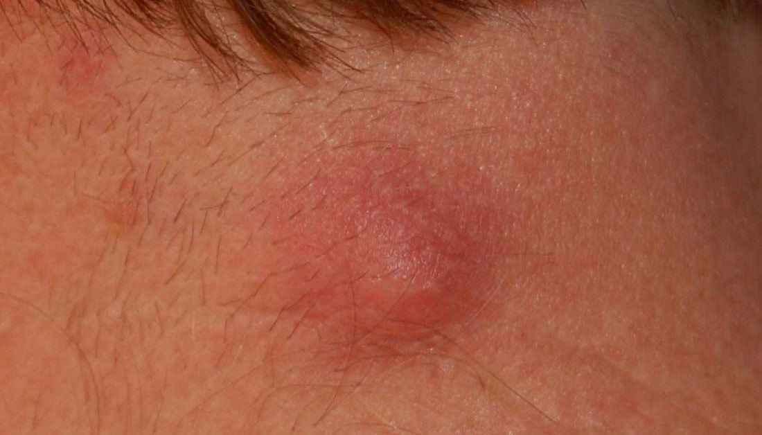 Lumps And Bumps On Head And Neck – NBKomputer