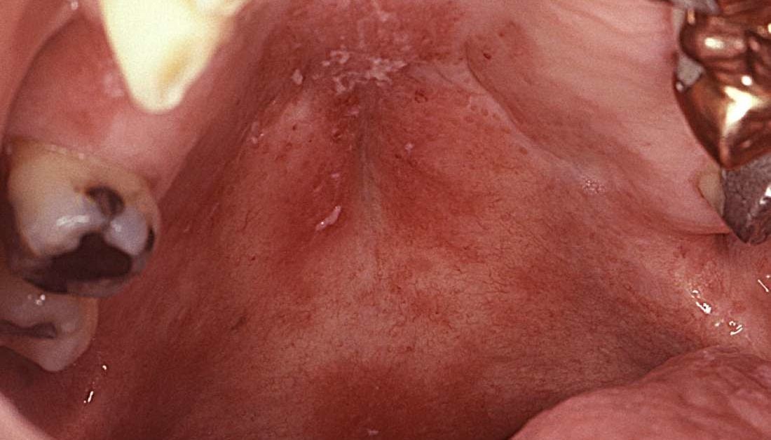 Red spots on roof of mouth: Causes and symptoms