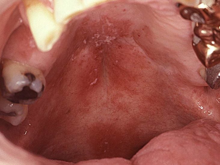 fordyce spots on tongue