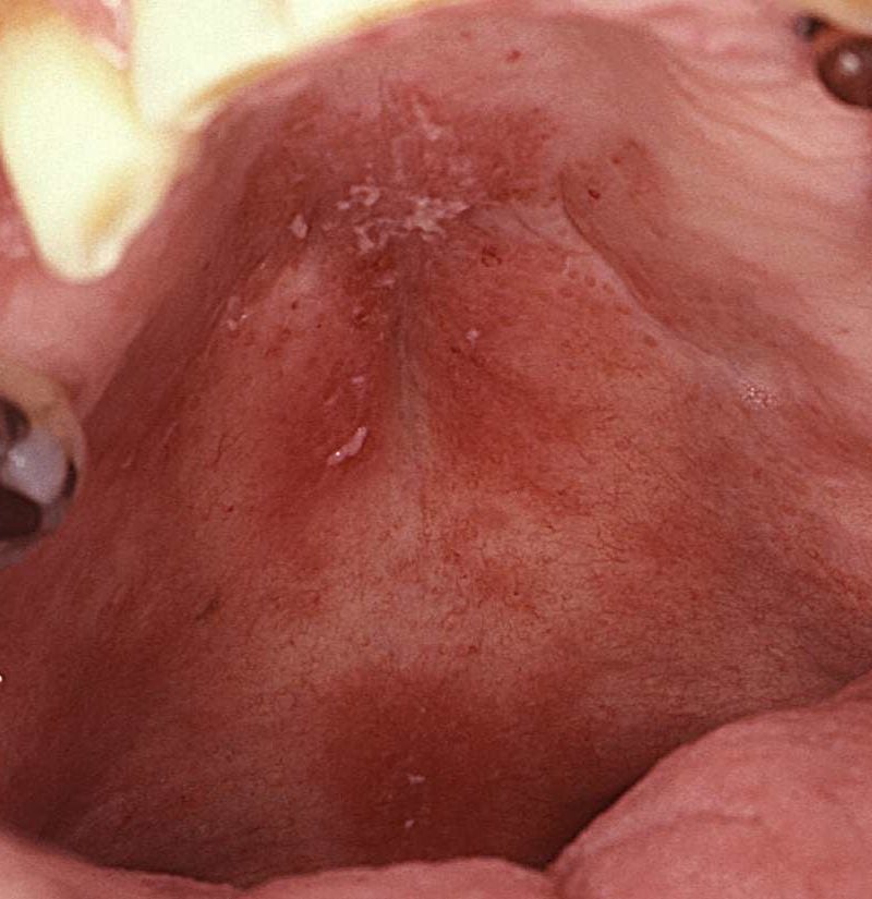 Nat sammen hjemmehørende Red spots on roof of mouth: Causes and other symptoms