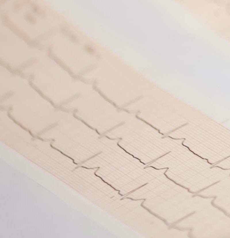 What Does Borderline Abnormal Ekg Mean