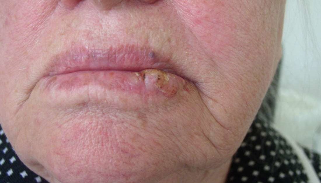 What Does Skin Cancer On The Lip Look Like