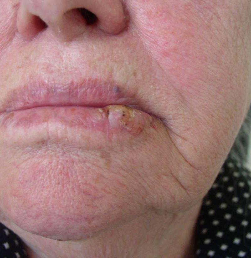 Hpv wart in mouth, Infecţia cu virusul HPV (Human papilloma virus), Hpv lip warts