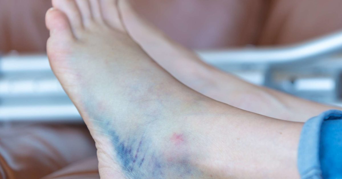 Bruised Heel Remedies And When To See A Doctor