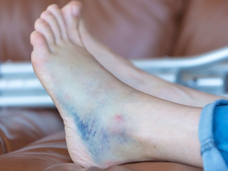 Bruised heel remedies and when to see a 