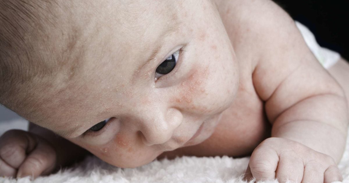 Dry Skin On A Baby S Face Causes And Remedies