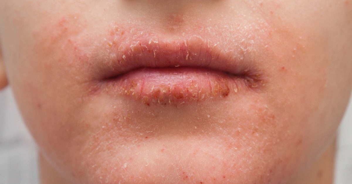 dry-skin-around-the-mouth-causes-treatment-and-remedies