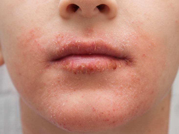 Dry skin around the mouth Causes, treatment, and remedies