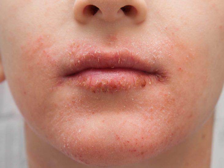 Rash around lips allergic reaction