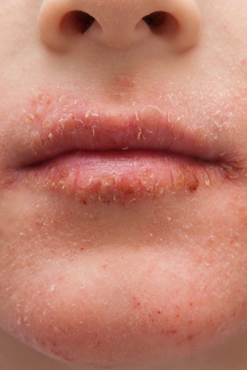 Dry skin around the mouth Causes, treatment, and remedies