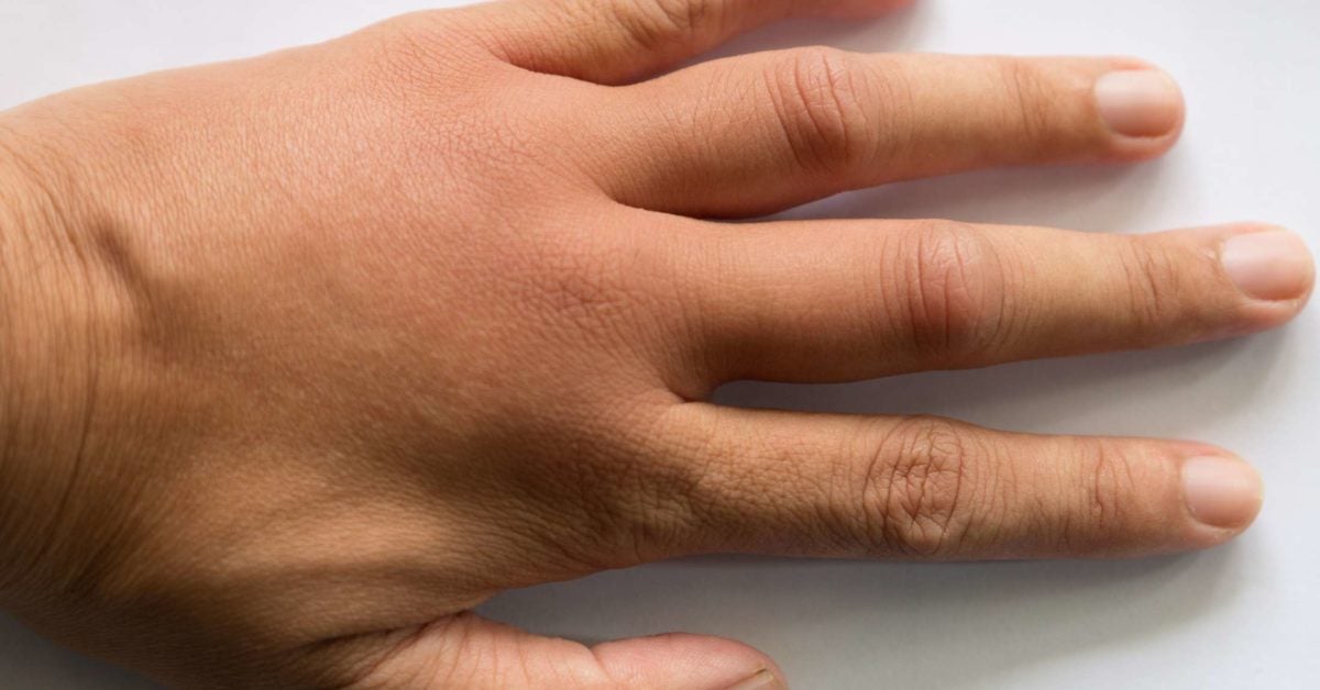 What Are The Causes Of Swollen Hands 