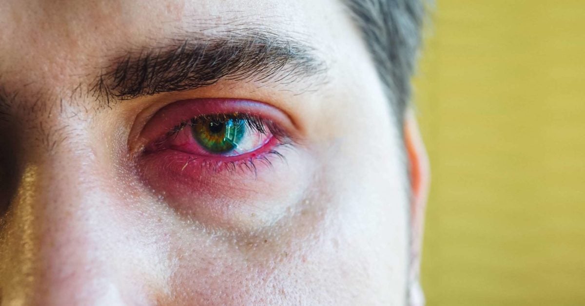 Sore Eyelid Causes When To See A Doctor And Treatment