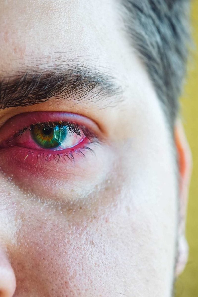 Sore Eyelid Causes When To See A Doctor And Treatment